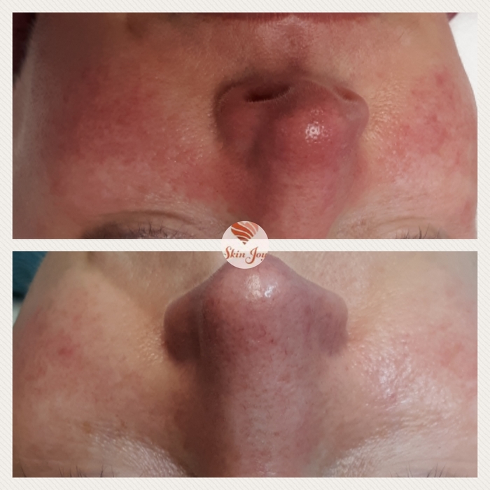 KP procell for rosacea 2